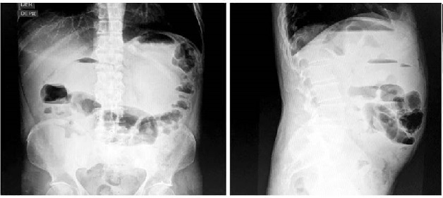 Radiograf&iacute;a abdomen simple de pie en la que se evidencian niveles hidroa&eacute;reos, sugestivos de obstrucci&oacute;n intestinal.
