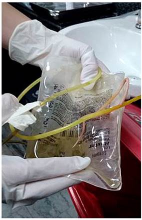 Gusano de &aacute;scaris en la sonda nasog&aacute;strica.