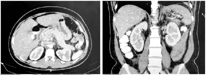 TAC con necrosis en el cuerpo del p&aacute;ncreas sin identificar colecciones definidas.