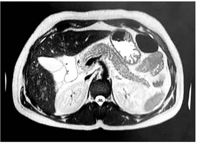 Colangiorresonancia con pancreatitis aguda edematosa intersticial con una colecci&oacute;n peripancre&aacute;tica de 32 x 23 mm.