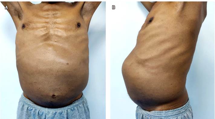 A. Se observa al paciente con distensión abdominal. B. Se observa el abdomen dilatado con presencia de la masa a nivel del epigastrio, mesogastrio e hipocondrio izquierdo.