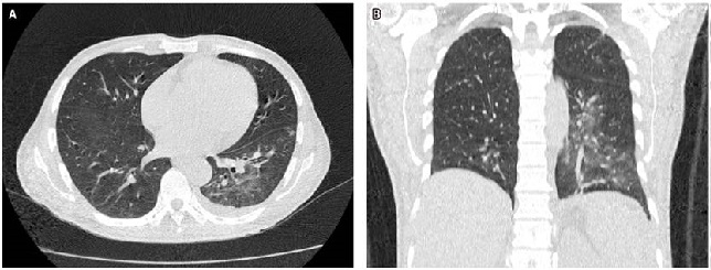 TAC de tórax. A. Corte transversal en el que se observa consolidación alveolar, con infiltración en ambas bases pulmonares en vidrio deslustrado. B. Corte coronal en el que se observa consolidación alveolar, con infiltración en base pulmonar izquierda en vidrio deslustrado.