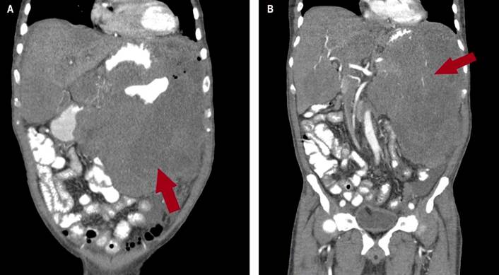 TAC de abdomen. A y B. En el corte coronal se observa una enorme masa tumoral de aspecto infiltrativo de aparente origen gástrico de aproximadamente 25 x 25 x17 cm, causado una extensa destrucción de la pared y de mucosa, infiltración endoluminal con crecimiento extragástrico e infiltración del bazo, del páncreas, de la raíz mesentérica, del omento mayor, del colon transverso y de asas intestinales delgadas; e infiltra el hilio hepático, como se observa en la flecha roja.