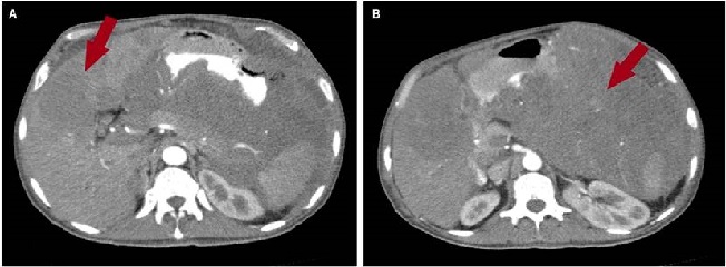 TAC de abdomen. A. Se observa a nivel hepático una lesión hipoatenuante de aspecto metastásico que mide 72 x 41 mm respectivamente en los segmentos hepáticos V y IV. B. En el corte coronal se observa una masa tumoral de aspecto infiltrativo de aparente origen gástrico, con crecimiento extragástrico con infiltración del bazo, páncreas, la raíz mesentérica, omento mayor, colon transverso, asas intestinales delgadas y el hilio hepático, como se observa en la flecha roja.