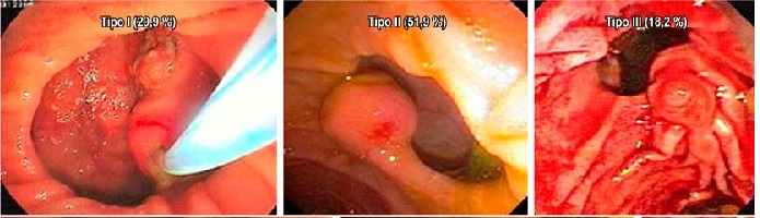 Distribución de los sujetos por tipo de DDP.