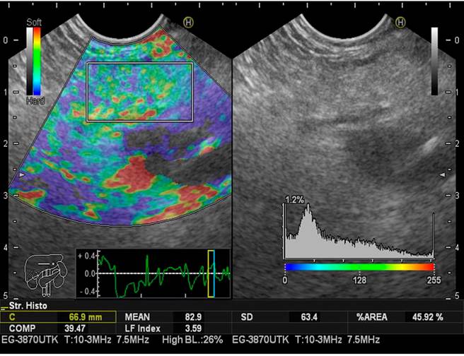 Elastograf&iacute;a e IFH en p&aacute;ncreas graso.