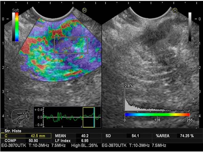 Elastograf&iacute;a e IFH en c&aacute;ncer de p&aacute;ncreas.
