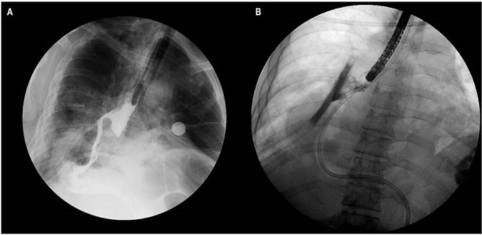 A. Esofagograma: trayecto fistuloso en la anastomosis esofagogástrica. B. Irrigación del medio de contraste, con extraluminización fuera de la pared esofágica.