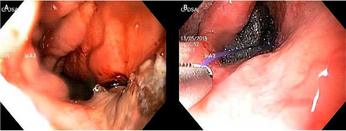 A. Visualización endoscópica de la fístula de la anastomosis esofagogástrica. B. Endo-Vac: inserción endoscópica de la esponja traccionada de material de sutura con pinza.