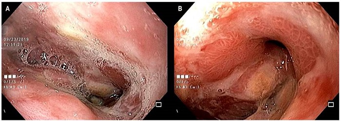 A. Aspecto de la anastomosis a los 3 meses de finalizar el tratamiento con Endo-Vac. B. Cambios inflamatorios secundarios.