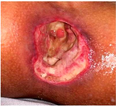 &Uacute;lcera perianal al ingreso a la instituci&oacute;n; tama&ntilde;o aproximado de 2 x 2 cm. N&oacute;tese la desaparici&oacute;n de las relaciones anat&oacute;micas del esf&iacute;nter anal.