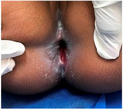 &Uacute;lcera perianal en control m&eacute;dico. Se evidencia desaparici&oacute;n del tejido expuesto, ahora epitelizado, con disminuci&oacute;n del tama&ntilde;o respecto a la inicial.