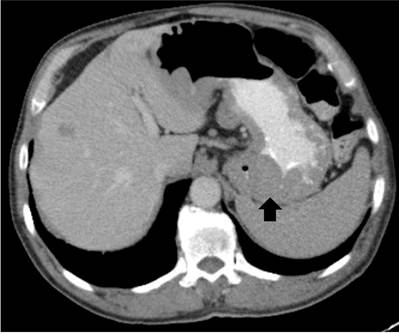 TC de abdomen contrastado. Engrosamiento de las paredes gástricas de predominio en fondo gástrico.