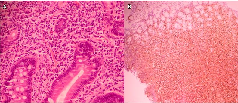 Histopatología e inmunohistoquímica. A. Infiltración duodenal por linfocitos pequeños, monótonos (tinción hematoxilina-eosina, 40x). B. Marcación nuclear positiva para ciclina D1 (40x).