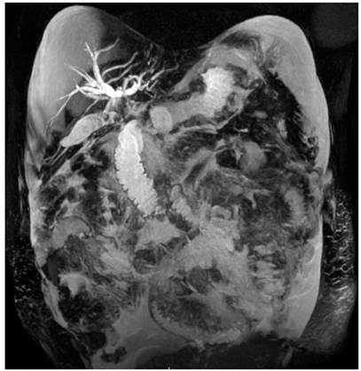 Colangiorresonancia 3D. Dilataci&oacute;n de la v&iacute;a biliar intrahep&aacute;tica. En los conductos hep&aacute;ticos derecho e izquierdo se observa transici&oacute;n abrupta y paso filiforme de l&iacute;quido en el conducto hep&aacute;tico com&uacute;n. Ves&iacute;cula biliar distendida con m&uacute;ltiples im&aacute;genes hipointensas, que ocupa en su interior l&iacute;quido perivesicular.