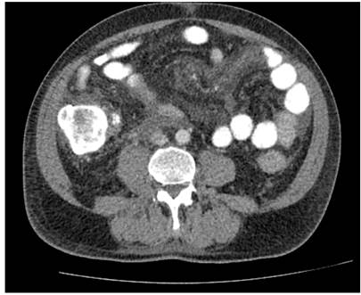 Ap&eacute;ndice cecal con medio de contraste en su luz, estriaci&oacute;n de la grasa periapendicular y, en contacto con su v&eacute;rtice, masa heterog&eacute;nea de contornos pobremente definidos, con &aacute;reas hipodensas y densas de 35 x 32 x 44 mm.