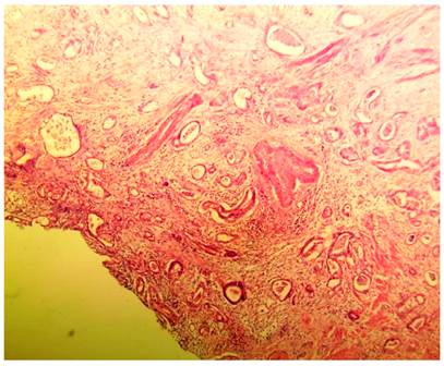 Hallazgos microsc&oacute;picos del esp&eacute;cimen quir&uacute;rgico. Tinci&oacute;n de hematoxilina y eosina, que muestra m&uacute;ltiples c&eacute;lulas tumorales, que infiltran la capa serosa apendicular hasta la submucosa.