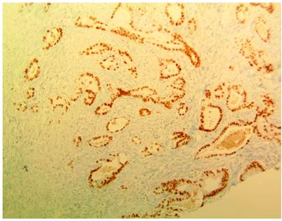 Inmunohistoqu&iacute;mica de material quir&uacute;rgico positivo para CK7.