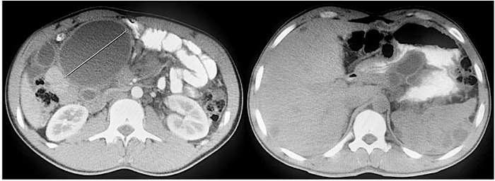 Tomografía abdominal y pélvica simple y contrastada. Corte axial que muestra numerosas lesiones redondeadas de contenido líquido, encapsuladas y distribuidas en la raíz del mesenterio, hígado, bazo y peritoneo.