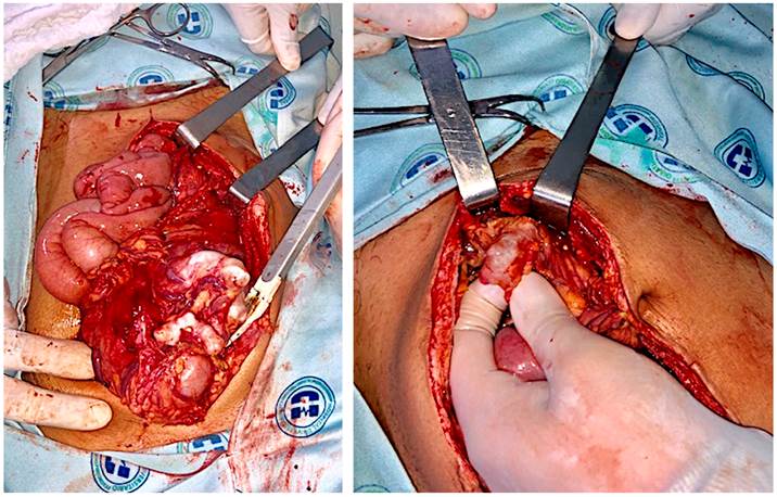Hallazgos intraoperatorios. Múltiples lesiones de aspecto quístico en el peritoneo y raíz del mesenterio.