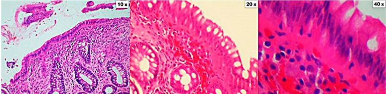 CC. Los cortes muestran la mucosa del colon distorsionada por la presencia de una banda de col&aacute;geno subepitelial engrosada, con atrapamiento focal de capilares, gl&oacute;bulos rojos y c&eacute;lulas inflamatorias. En la l&aacute;mina propia hay un importante infiltrado inflamatorio, el cual est&aacute; compuesto por linfocitos, c&eacute;lulas plasm&aacute;ticas y eosin&oacute;filos (aumento de 10x, 20x y 40x). Coloraci&oacute;n de hematoxilina y eosina (H&E).