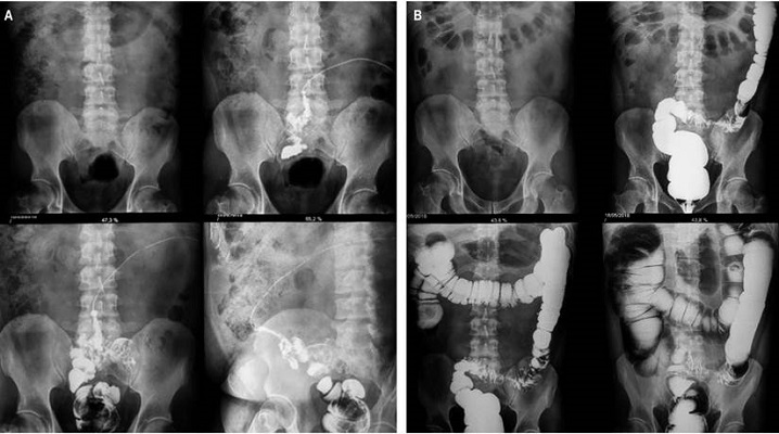 Fistulograf&iacute;a. A. Se coloc&oacute; sonda fina a nivel del orificio fistuloso en la regi&oacute;n umbilical por donde se inyect&oacute; contraste. Se aprecia el trayecto fistuloso de 9 cm de longitud comunicando con el colon sigmoide, repleci&oacute;n del mismo y de la ampolla rectal. B. El colon por enema baritado a doble contraste evidenci&oacute; un estrechamiento fusiforme de todo el colon sigmoide con la presencia de divert&iacute;culos.