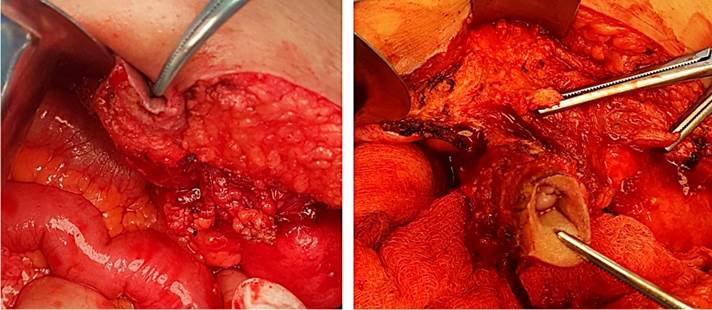 Momento de la cirug&iacute;a en que se reseca el ombligo junto al trayecto fistuloso.