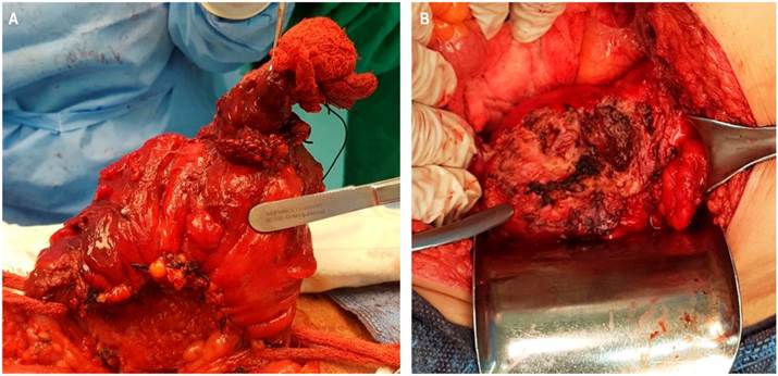 A. Se aprecia el colon sigmoide con su meso ya ligado y seccionado, con sus dos extremos referidos con gasa, y el trayecto fistuloso en la parte medial que comunica el sigmoide con el ombligo aislado con una gasa. B. Fondo de la vejiga donde el colon sigmoide y epipl&oacute;n mayor estaban adheridos conformando un plastr&oacute;n abscedado. Se muestra la vejiga despu&eacute;s de haber desintegrado el plastr&oacute;n, retirado el tejido desvitalizado y el pus.