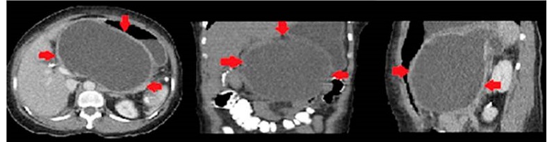 Tomografía computarizada de abdomen y pelvis. Presencia de pseudoquiste pancreático de 16 x 16 x 11 cm, sin líquido libre en la cavidad.