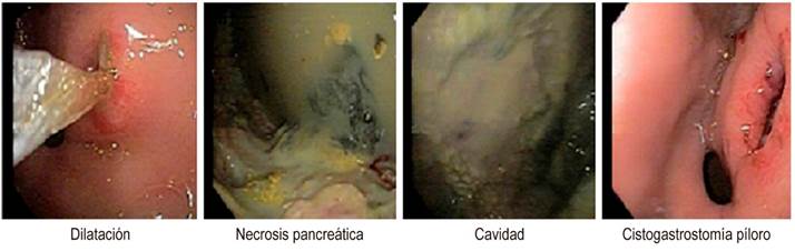 Drenaje de pseudoquiste.
