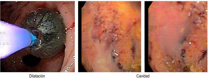 Evolución del manejo endoscópico.