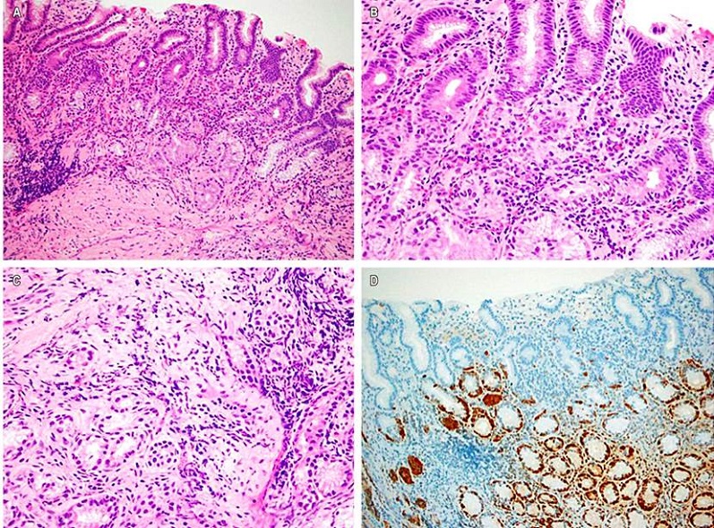 Biopsia de mucosa gástrica corporal. A. Mucosa de tipo oxíntica con pérdida de células parietales y antralización de la mucosa, acompañada por un infiltrado inflamatorio difuso que compromete todo el espesor de la mucosa (Hematoxilina-eosina 100X). B. Inflamación linfoplasmocitaria en la lámina propia, rica en células plasmáticas, y acompañada por eosinófilos, en la que se observa permeación de las glándulas. C. Micronódulos de células neuroendocrinas en la mucosa (Hematoxilina-eosina 400X). D. Estudio de inmunohistoquímica para cromogranina que corroboró la presencia de una proliferación lineal y nodular de células neuroendocrinas (100x). Fuente: propiedad de los autores.