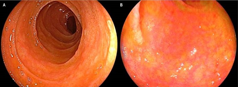 Compromiso por EICH en mucosa duodenal. A. Visi&oacute;n endosc&oacute;pica con luz blanca que demuestra una reducci&oacute;n en el tama&ntilde;o y grosor de pliegues duodenales, con mucosa de aspecto atr&oacute;fico. B. Visi&oacute;n con cromoendoscopia LCI (linked-color imaging) en la que se encontr&oacute; adelgazamiento de la mucosa, con signos de atrofia y acortamiento de vellosidades.