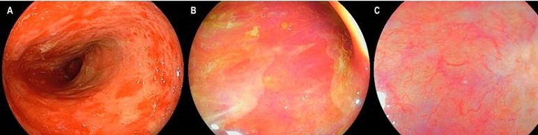 Compromiso por EICH en el &iacute;leon terminal. A. Visi&oacute;n endosc&oacute;pica con luz blanca que demuestra esfacelaci&oacute;n de la mucosa ileal en parches, atrofia y marcada friabilidad. B. Visi&oacute;n con LCI que demuestra una zona de denudaci&oacute;n con ausencia de vellosidades, hallazgos que se confirman en C al realizar valoraci&oacute;n por LCI con magnificaci&oacute;n.