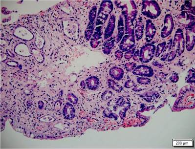 Intestino delgado comprometido por EICH. Biopsia de intestino delgado con hematoxilina y eosina (H&E: 200 X). Destrucci&oacute;n de criptas con cambios en su forma y tama&ntilde;o, algunas atr&oacute;ficas con cuerpos apopt&oacute;ticos basales, adem&aacute;s de denudaci&oacute;n del epitelio superficial. EICH grave.