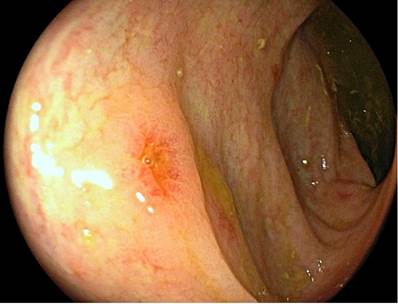 Ulceraci&oacute;n col&oacute;nica por EICH. Ulceraci&oacute;n &uacute;nica en el colon de bordes congestivos.