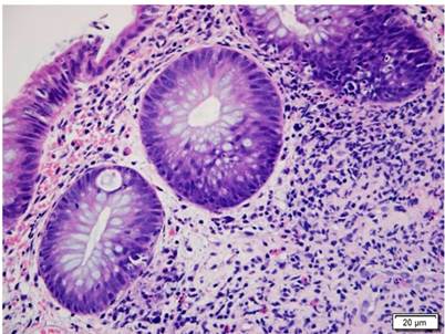 Colon comprometido por EICH. Histopatolog&iacute;a de colon con H&E (400 X). Muestra el da&ntilde;o de criptas con cuerpos apopt&oacute;ticos basales e infiltrado inflamatorio mixto en la l&aacute;mina propia alrededor de las criptas. EICH grado 1.