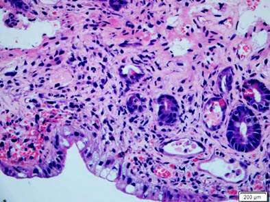 Intestino delgado con compromiso por EICH. Histopatolog&iacute;a del intestino delgado con H&E (400 X). Resalta una franca disminuci&oacute;n en la cantidad de criptas con depleci&oacute;n marcada de mucina, presencia de cuerpos apopt&oacute;ticos basales e infiltrado inflamatorio mixto adyacente. EICH grave.