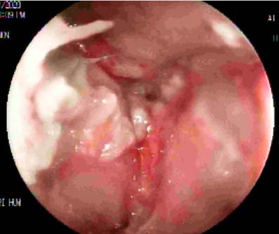 Masa con efecto obstructivo completo en el canal anal.