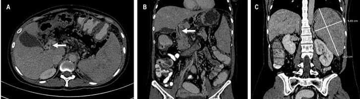A. No hay adecuada opacificaci&oacute;n de la vena porta (flecha blanca). B. Vena porta, en su trayecto se observan m&uacute;ltiples im&aacute;genes vasculares serpentiformes que se dirigen al hilio hep&aacute;tico y sugieren hipertensi&oacute;n portal (flecha blanca). C. Esplenomegalia (l&iacute;nea blanca).