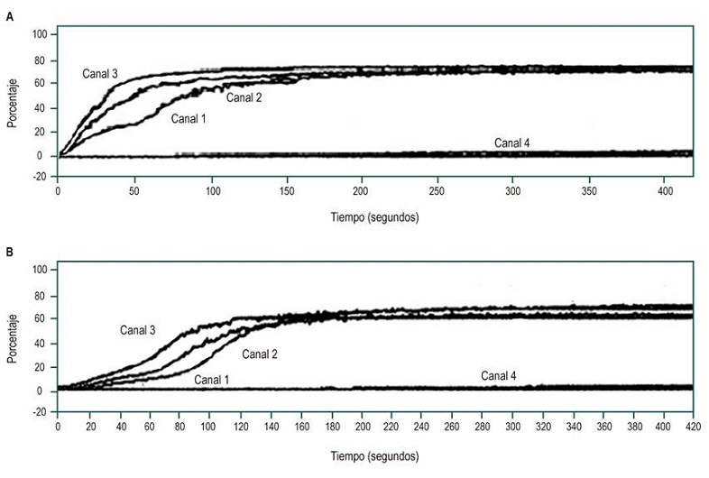 A. Estudio de agregaci&oacute;n plaquetaria con ADP compatible con plaqueta pegajosa. Canales: 1: no se observa hiperagregaci&oacute;n plaquetaria con ADP a una concentraci&oacute;n de 2,3 &micro;M; 2: se observa hiperagregaci&oacute;n plaquetaria con ADP a una concentraci&oacute;n 1,2 &micro;M; 3: se observa hiperagregaci&oacute;n plaquetaria con ADP a una concentraci&oacute;n de 0,6 &micro;M; 4: control negativo con soluci&oacute;n salina (SS) al 0,85 %. B. Estudio de agregaci&oacute;n plaquetaria con epinefrina compatible con plaqueta pegajosa. Canales: 1: no se observa hiperagregaci&oacute;n plaquetaria con epinefrina a una concentraci&oacute;n de 11 &micro;M. 2: se observa hiperagregaci&oacute;n plaquetaria con epinefrina a una concentraci&oacute;n de 1,1 &micro;M; 3: se observa hiperagregaci&oacute;n plaquetaria con epinefrina a una concentraci&oacute;n 0,6 &micro;M; 4: control negativo con SS al 0,85 %.