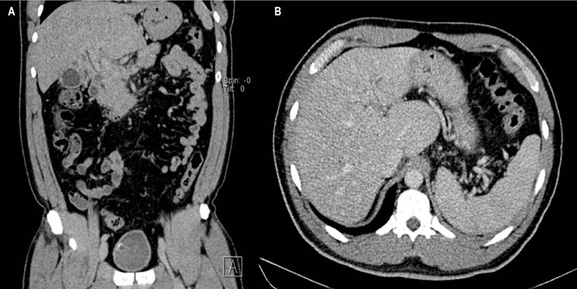 A. CT scan of the abdomen contrasted with findings of chronic liver disease and multiple venous collaterals. B. Findings of liver disease (nodularity of liver lobes) and splenomegaly. Source: Authors&rsquo; archive.