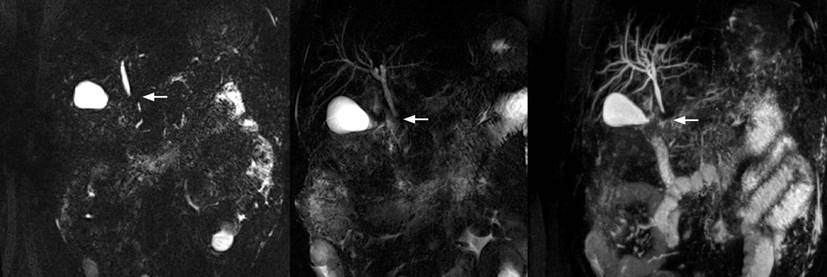 Stenosis in the distal common bile duct, with extrinsic compression image. Source: Source: Authors’ archive.