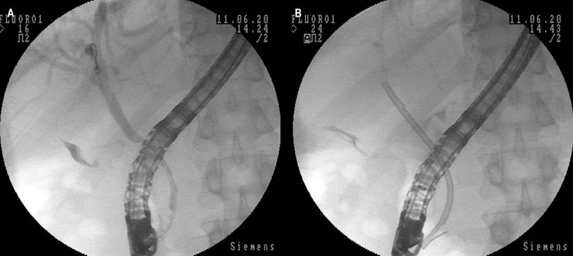 Images of ERCP. A. Decrease in diameter of the distal common bile duct with an appearance that impresses by extrinsic compression. B. Placement of plastic biliary stent, with evident elimination of the contrast medium of the bile duct. Source: Authors’ archive.