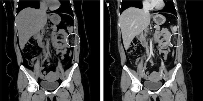 A. Appendagitis, coronal court S/C. B. Appendagitis, coronal court C/C. Source: Authors’ archive.