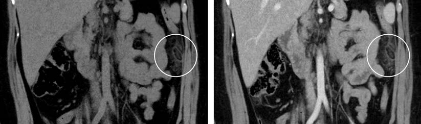 Hypodense image (circumscribed by a white circle) of fat density, oval, which contains a hyperdense image (the sign of the central point) inside compatible with epiploic appendagitis. Source: Authors’ archive