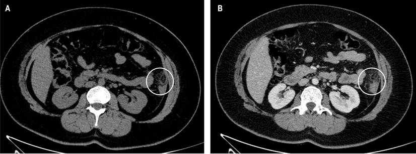 A. Appendagitis, horizontal cut S/C. B. Appendagitis, horizontal cut C/C. Source: Authors’ archive.