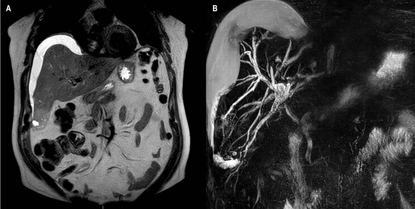 Magnetic resonance cholangiopancreatography. A. In sequence T2, subcapsular collection: bilioma. B. 3D reconstruction of the bile duct. Image Archive of Hospital Universitario Hernando Moncaleano Perdomo in Neiva.
