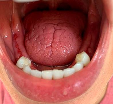 Dorsal tongue with depapilation and deep fissures without ulceration, findings compatible with glossitis resulting from oral xerostomia. Evidence of areas of post-extraction scarring in the lower alveolar ridge mucosa before implant treatment. Common nonspecific oral manifestations associated with inflammatory bowel disease (IBD). Authors’ archives.
