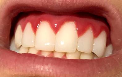 Erythematous gums with enlarged interproximal dental papillae of generalized manifestation compatible with the diagnosis of gingivitis. Common nonspecific oral manifestation associated with IBD. Authors’ archives.